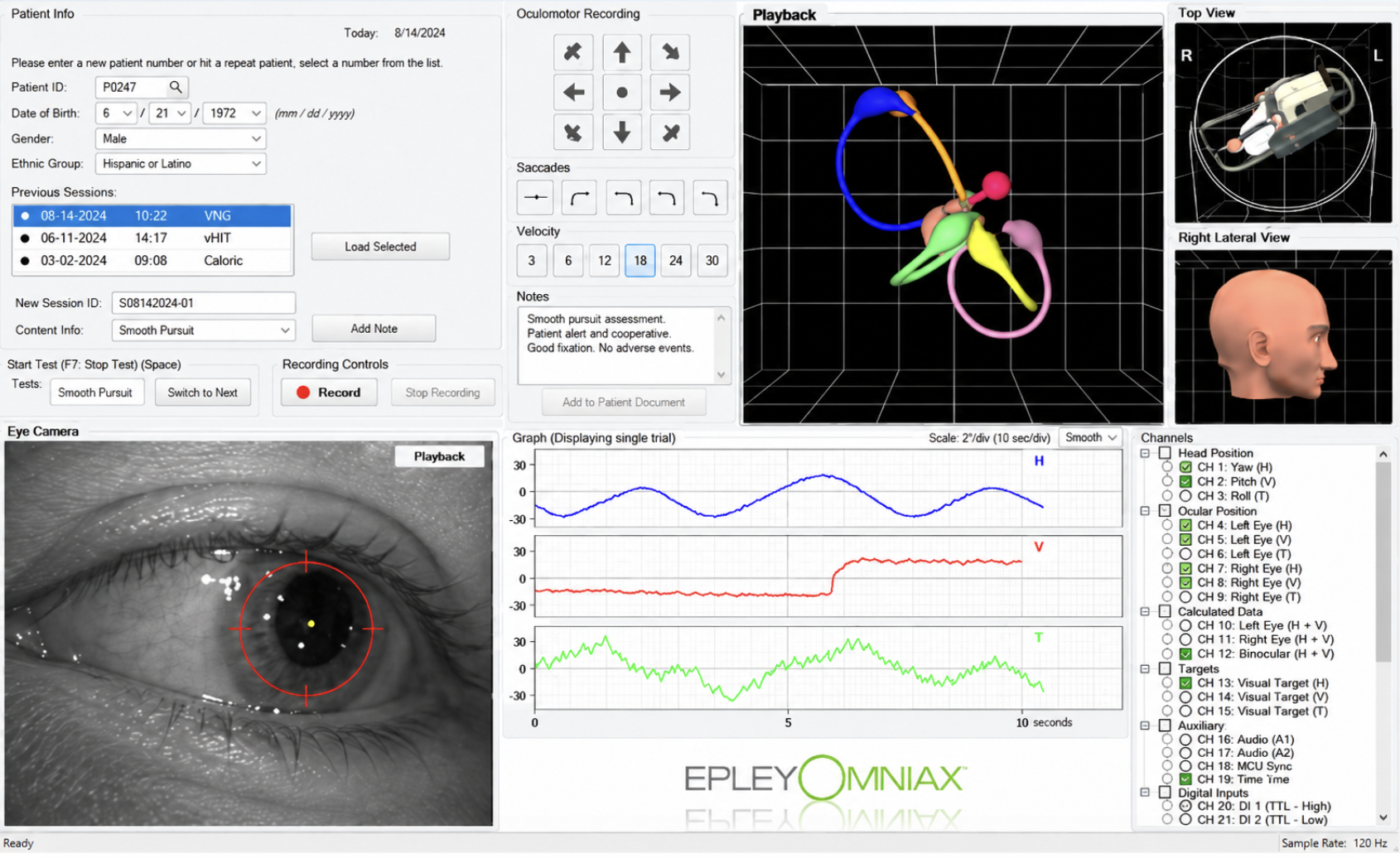 Epley Omniax software interface showing 3D canal model, pupil camera tracking, and H/V/T nystagmus traces